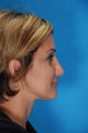 Rhinoplasty (nose job, nasal surgery)