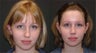 Rhinoplasty