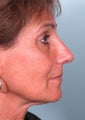 Rhinoplasty