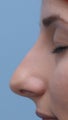 Rhinoplasty