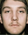 Rhinoplasty