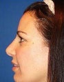 Rhinoplasty