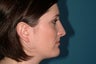 Rhinoplasty