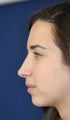Rhinoplasty