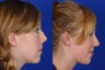 Rhinoplasty