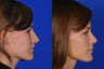 Rhinoplasty