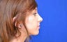 Rhinoplasty
