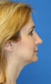 Rhinoplasty