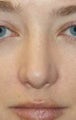 Rhinoplasty