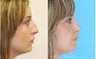 Rhinoplasty