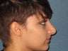 Rhinoplasty