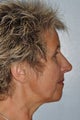Rhinoplasty