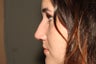 Rhinoplasty