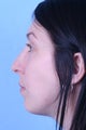 Rhinoplasty