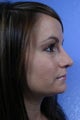 Rhinoplasty