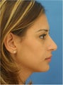 Rhinoplasty