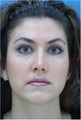 Rhinoplasty