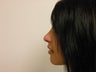 Rhinoplasty