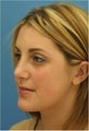Rhinoplasty