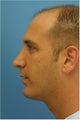 Rhinoplasty, Chin Implant