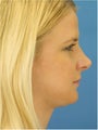 Rhinoplasty, Submental Liposuction and Buccal Fat Excision
