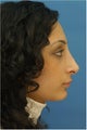Rhinoplasty