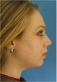 Rhinoplasty