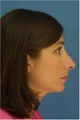 Rhinoplasty