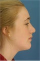 Rhinoplasty, Chin Implant