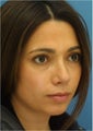 Rhinoplasty