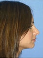 Rhinoplasty
