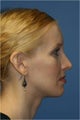 Rhinoplasty, Cheek Implants