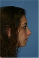 Rhinoplasty