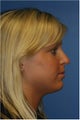 Rhinoplasty