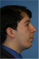 Rhinoplasty, Chin Implant, Submental Liposuction, Otoplasty