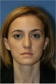 Rhinoplasty