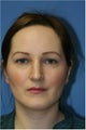 Rhinoplasty