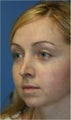 Rhinoplasty
