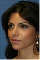 Rhinoplasty