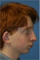Rhinoplasty
