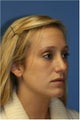 Rhinoplasty