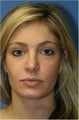 Rhinoplasty