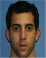 Rhinoplasty