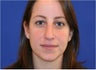 Rhinoplasty