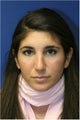 Rhinoplasty