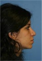 Rhinoplasty