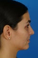 Rhinoplasty