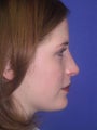 Rhinoplasty