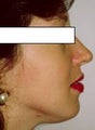 Rhinoplasty