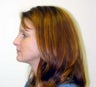 Rhinoplasty